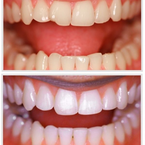 Bělení zubu před a po