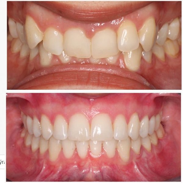 zubni rovnatka pred a po